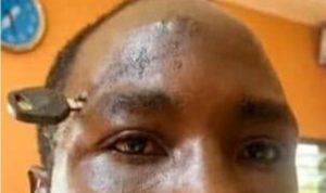Doctors Successfully Remove Motorbike Key from Farmer’s Skull After Fight Intervention Turns Violent